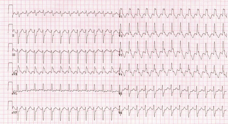 Tracciato elettrocardiografico
