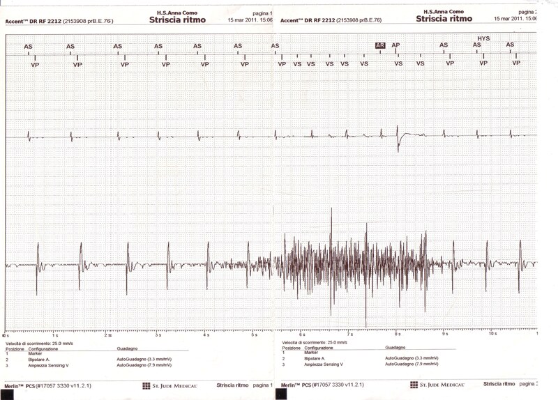 Controllo dispositivo cardiaco impiantabile