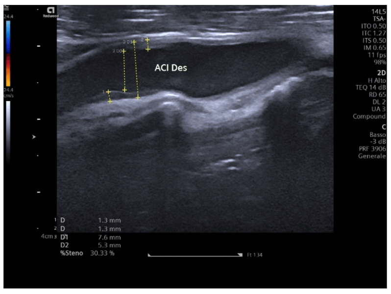 Ecodoppler dei tronchi sovraaortici